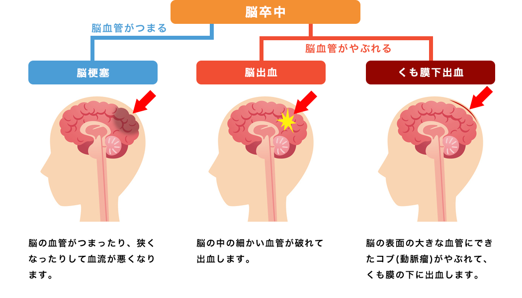 前兆を伴う片頭痛とは何ですか?